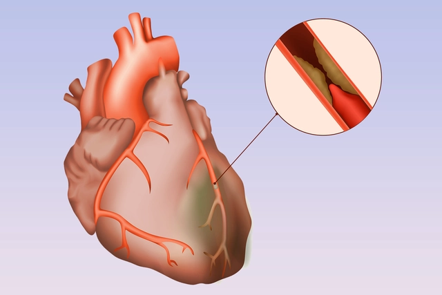 The Connection Between Depression and Coronary Artery Disease