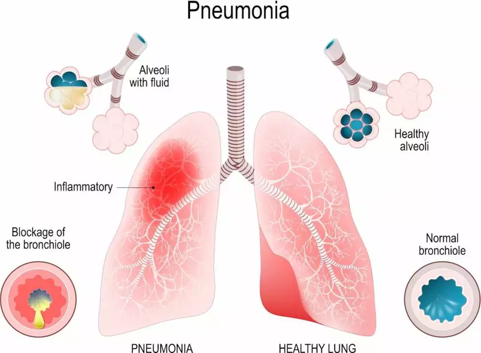 Azathioprine and the Risk of Pneumonia: A Comprehensive Review